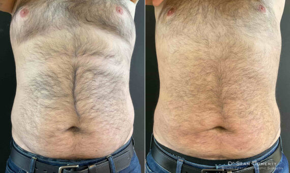 Liposuction Before and After Photos in Boston, MA, Patient 9152