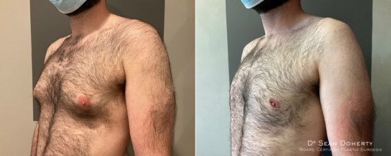 Gynecomastia Before and After Photos in Boston, MA, Patient 9192