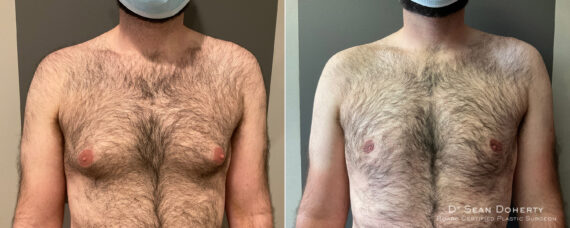 Gynecomastia Before and After Photos in Boston, MA, Patient 9192