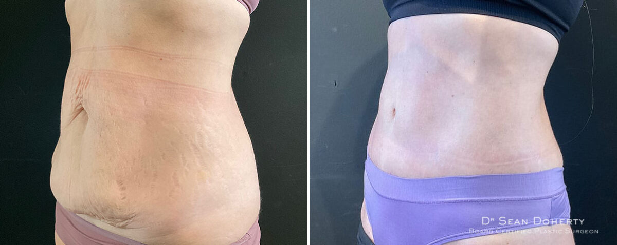 Tummy Tuck Before and After Photos in Boston, MA, Patient 9828
