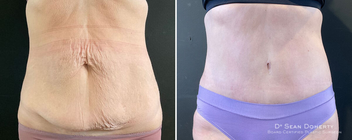 Tummy Tuck Before and After Photos in Boston, MA, Patient 9828