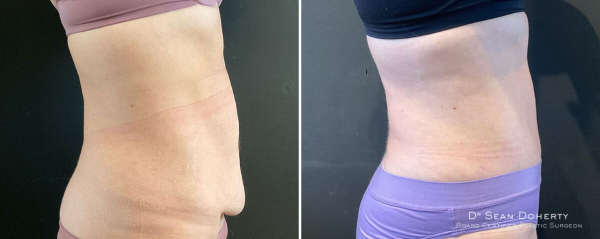 Tummy Tuck Before and After Photos in Boston, MA, Patient 9828