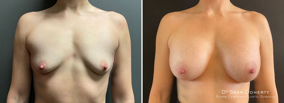 Breast Augmentation Before and After Photos in Boston, MA, Patient 9949