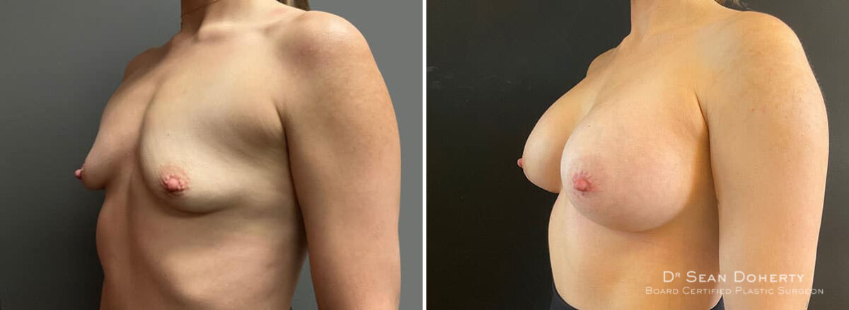 Breast Augmentation Before and After Photos in Boston, MA, Patient 9949