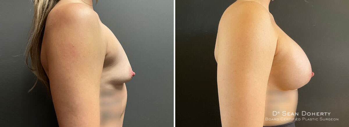 Breast Augmentation Before and After Photos in Boston, MA, Patient 9949